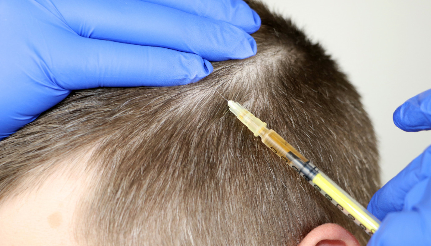 PRP Hair Treatment in London: What Results Can You Really Expect ?